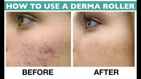 dermaroller before after|Derma Rolling Before and After: What to Use .
